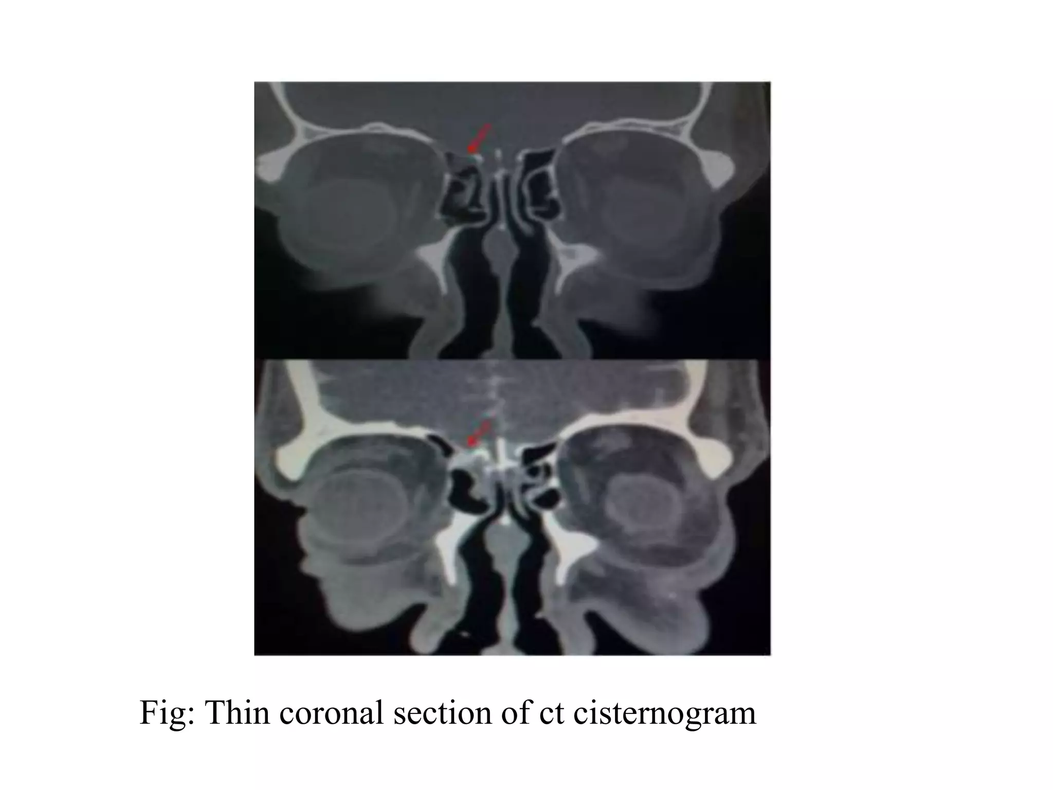 Fig: Thin coronal section of ct cisternogram
 