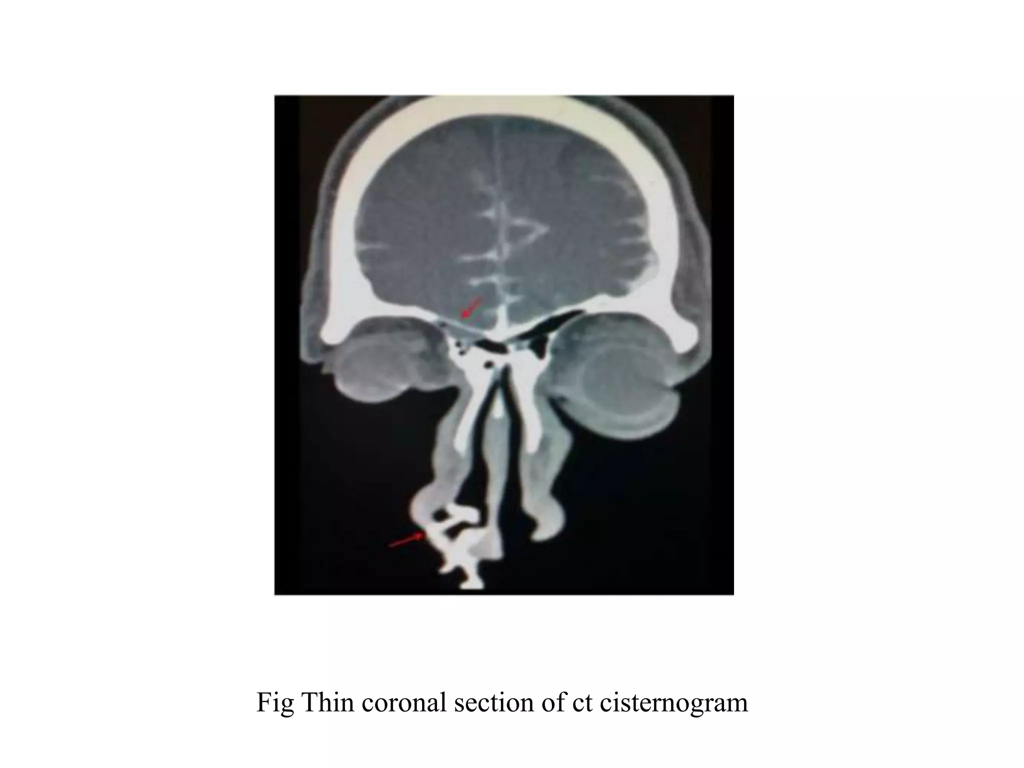 Fig Thin coronal section of ct cisternogram
 