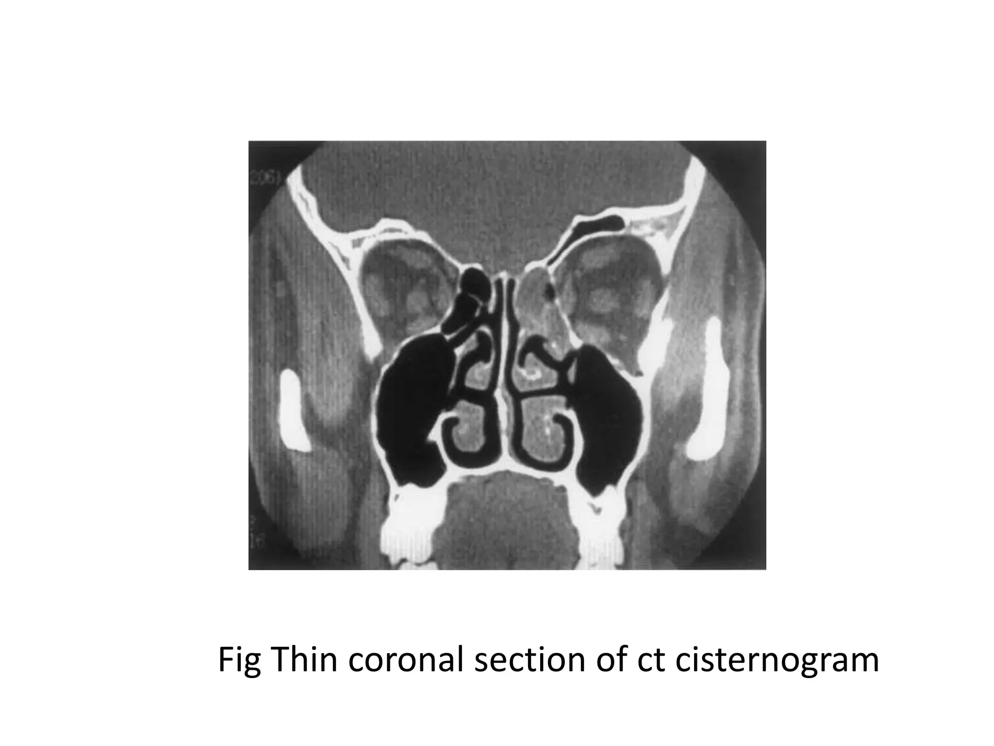 Fig Thin coronal section of ct cisternogram
 