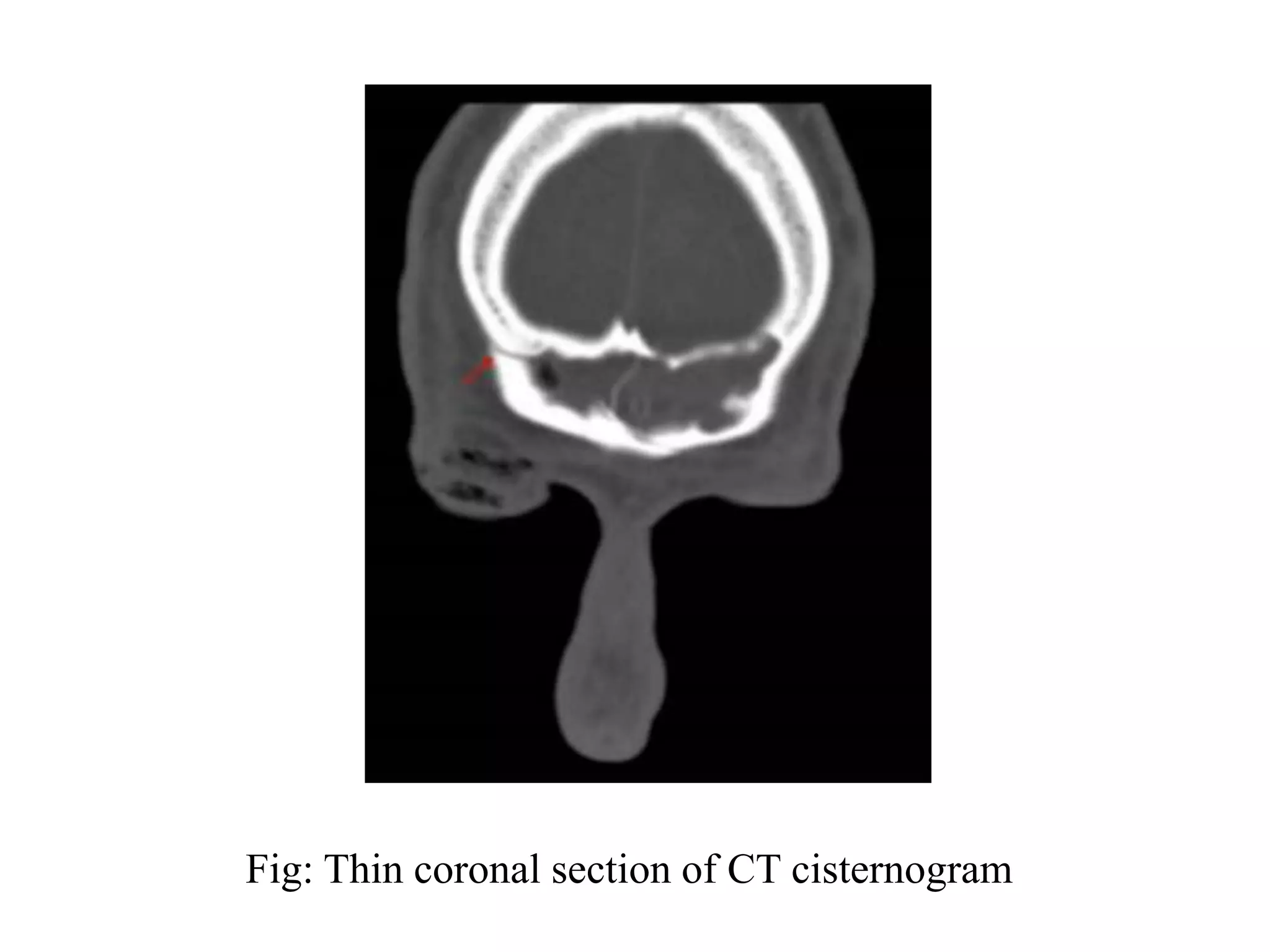 Fig: Thin coronal section of CT cisternogram
 