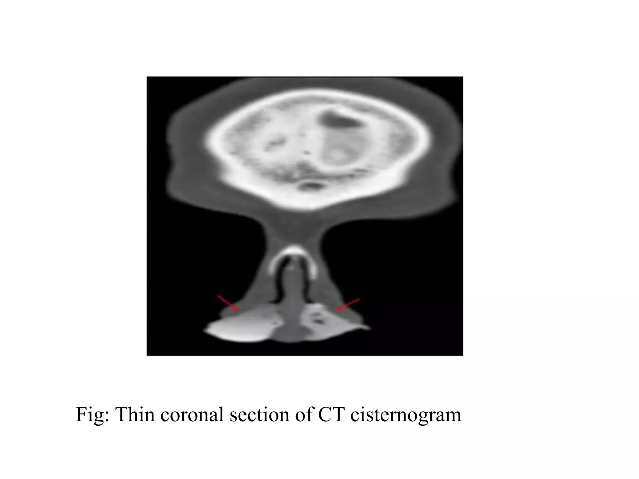 Fig: Thin coronal section of CT cisternogram
 