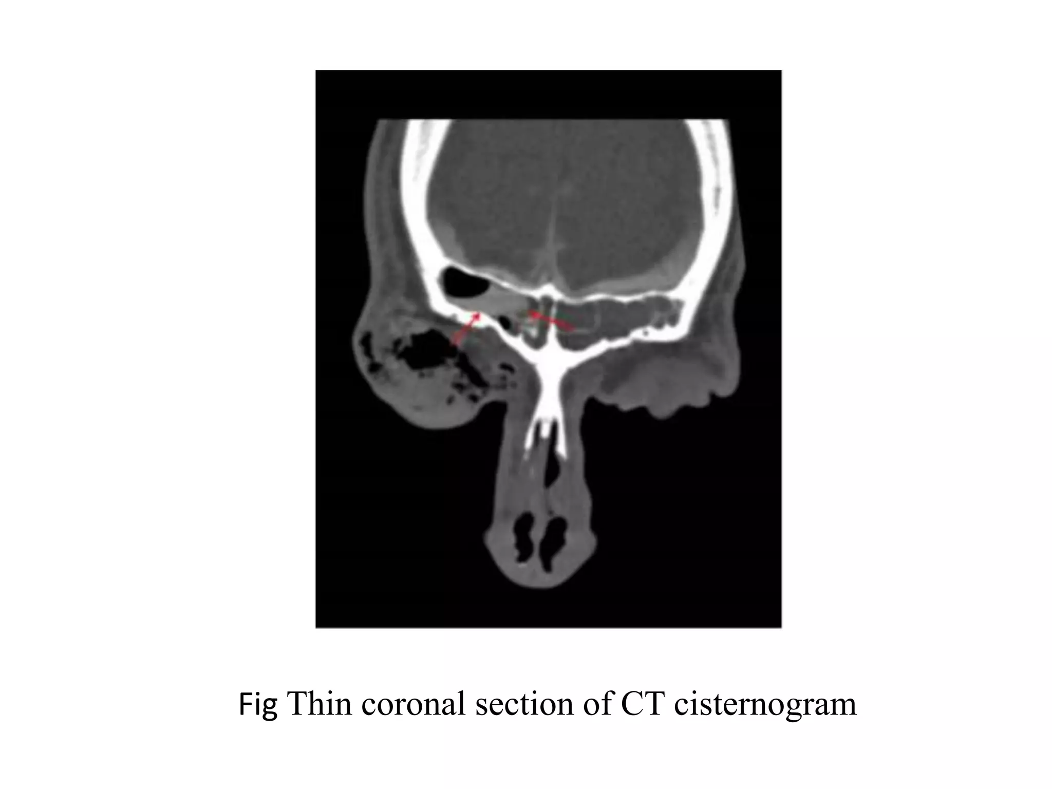 Fig Thin coronal section of CT cisternogram
 