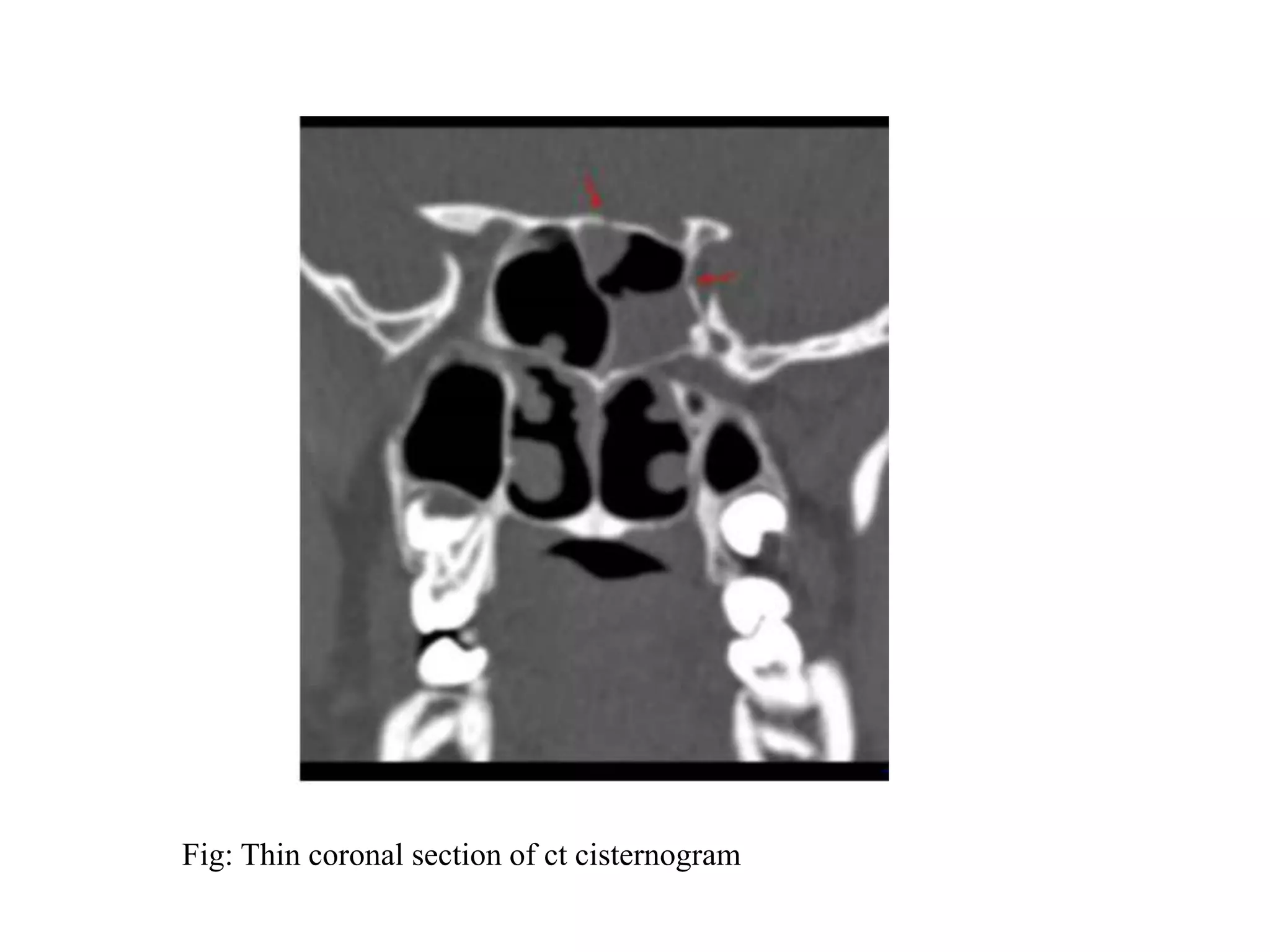 Fig: Thin coronal section of ct cisternogram
 
