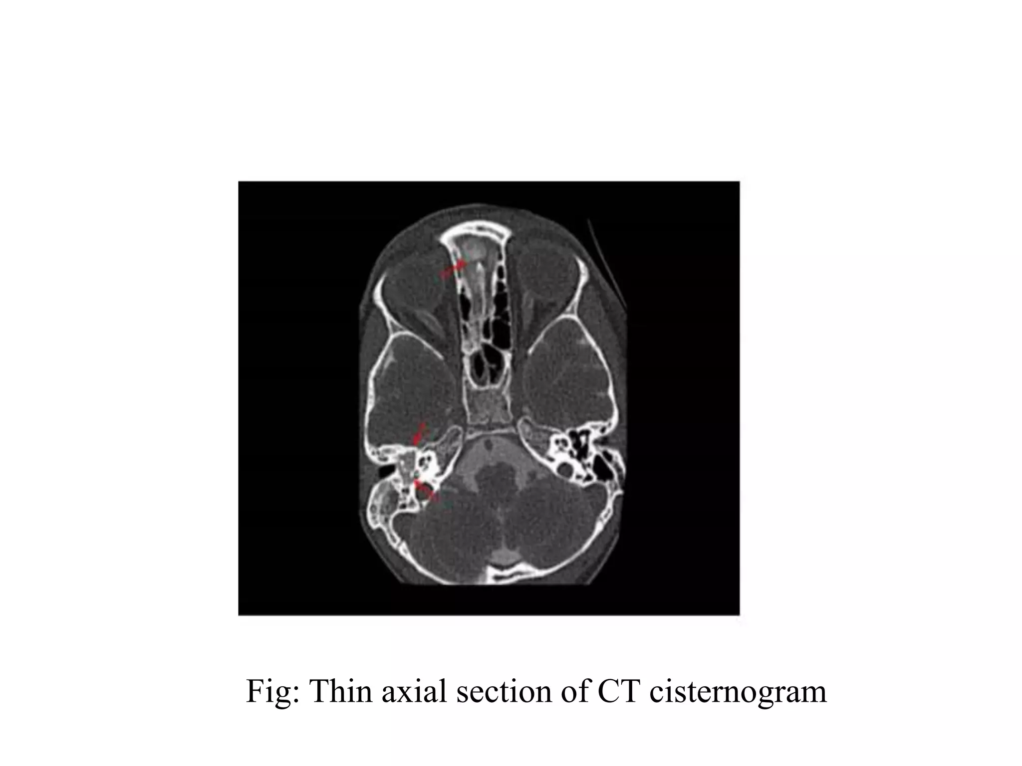 Fig: Thin axial section of CT cisternogram
 