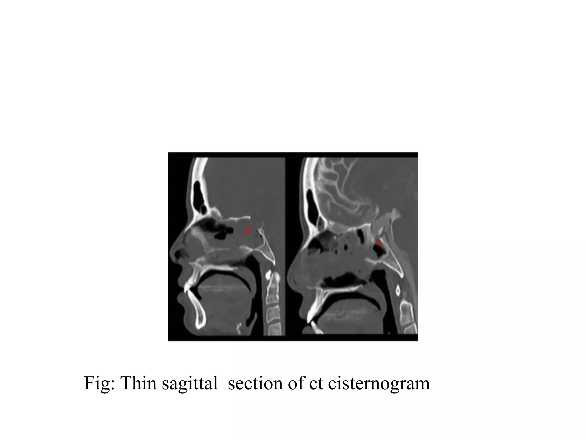 Fig: Thin sagittal section of ct cisternogram
 