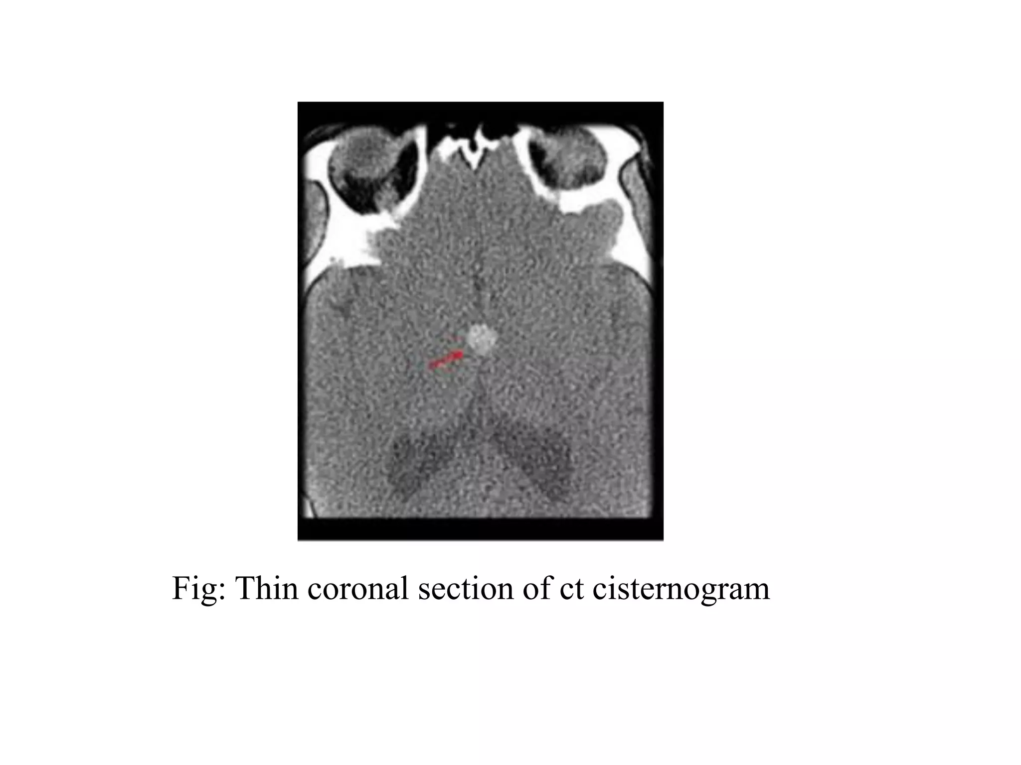 Fig: Thin coronal section of ct cisternogram
 