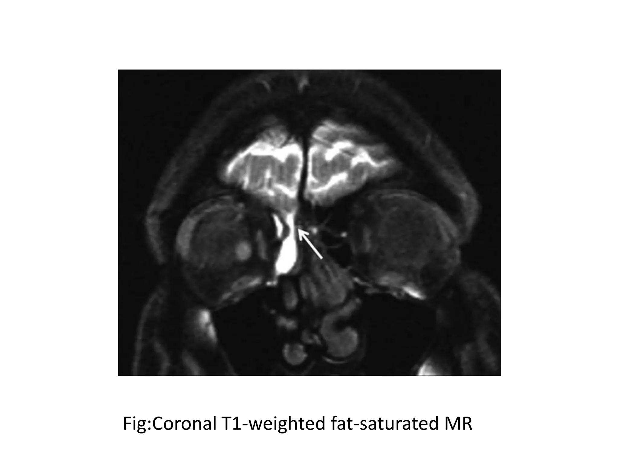 Fig:Coronal T1-weighted fat-saturated MR
 