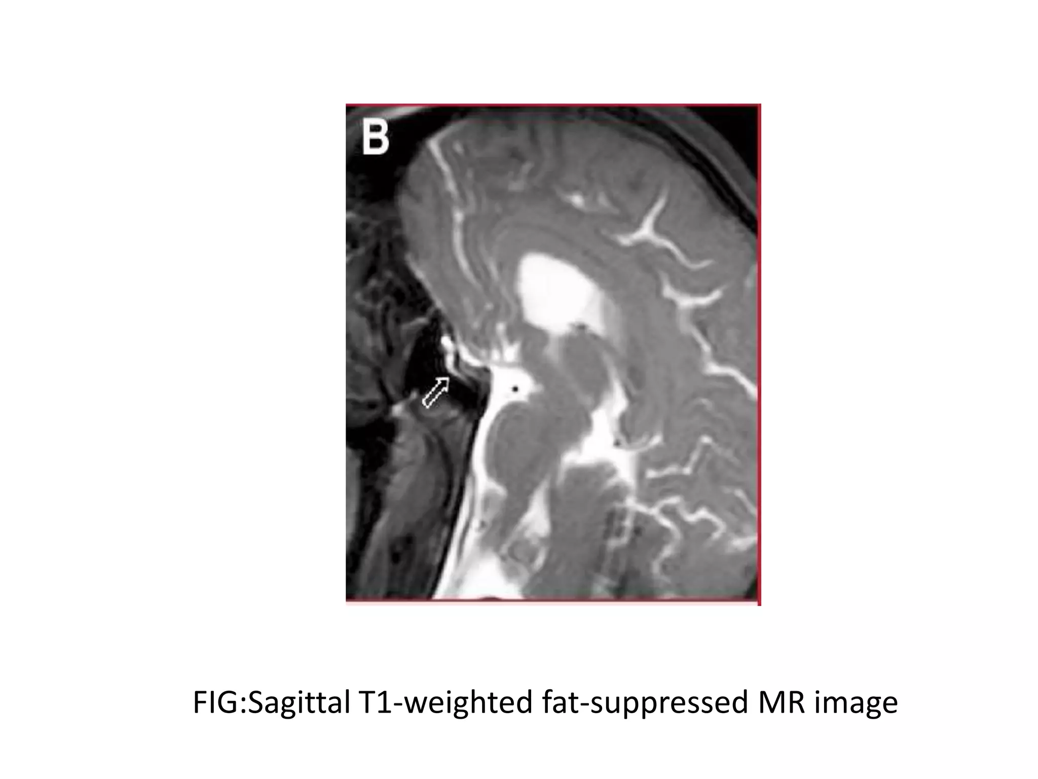 FIG:Sagittal T1-weighted fat-suppressed MR image
 