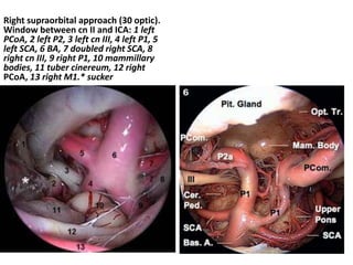 ENDOSCOPIC ENDONASAL PITUITARY
TRANSPOSITION FOR A TRANSDORSUM SELLAE
APPROACH TO THE INTERPEDUNCULAR CISTERN
http://www.n...
