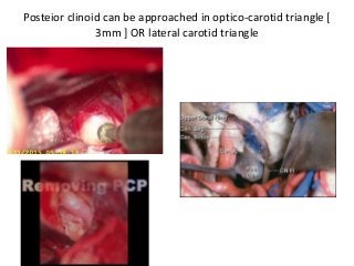 posterior clinoidectomy by middle cranial fossa approach needs lot of training – see
in this cisternostomy video https://w...