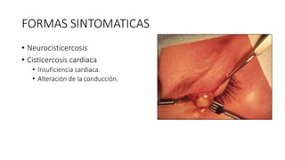 FORMAS SINTOMATICAS
• Neurocisticercosis
• Cisticercosis cardiaca
• Insuficiencia cardiaca.
• Alteración de la conducción.
 