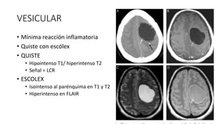 VESICULAR
• Mínima reacción inflamatoria
• Quiste con escólex
• QUISTE
• Hipointenso T1/ hiperintenso T2
• Señal = LCR
• ESCOLEX
• Isointenso al parénquima en T1 y T2
• Hiperintenso en FLAIR
 
