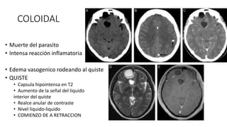 COLOIDAL
• Muerte del parasito
• Intensa reacción inflamatoria
• Edema vasogenico rodeando al quiste
• QUISTE
• Capsula hipointensa en T2
• Aumento de la señal del liquido
interior del quiste
• Realce anular de contraste
• Nivel liquido-liquido
• COMIENZO DE A RETRACCION
 