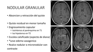 NODULAR GRANULAR
• Absorcion y retracción del quiste
• Quiste residual en menor tamaño
• Engrosamiento capsular
• Isointenso al parénquima en T1
• Iso hipotenso en T2
• Escolex calsificado (aspecto de diana)
• *Leve edema vasogenico
• Realce nodular o micronodular con
contraste
 