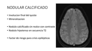 NODULAR CALCIFICADO
• Involucion final del quiste
• Mineralizacion
• Nodulo calcificado sin realce con contraste
• Nodulo hipotenso en secuencia T2
• Factor de riesgo para crisis epilépticas
 