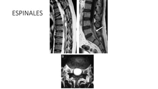 ESPINALES
 