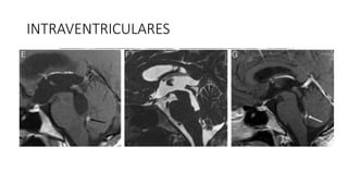 INTRAVENTRICULARES
 