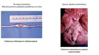 Cisticercus cellulosae en médula espinal
De mejor pronóstico
Más frecuente en población pediátrica y en Asia
Severa: adultos sintomáticos
Cisticercus racemosos en espacio
subaracnoideo
 