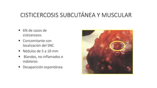 CISTICERCOSIS SUBCUTÁNEA Y MUSCULAR
 6% de casos de
cisticercosis
 Concomitante con
localización del SNC
 Nódulos de 5 a 10 mm
 Blandos, no inflamados e
indoloros
 Desaparición espontánea
 