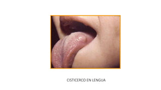 CISTICERCO EN LENGUA
 
