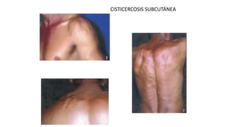 CISTICERCOSIS SUBCUTÁNEA
 