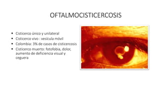OFTALMOCISTICERCOSIS
 Cisticerco único y unilateral
 Cisticerco vivo : vesícula móvil
 Colombia: 3% de casos de cisticercosis
 Cisticerco muerto: fotofobia, dolor,
aumento de deficiencia visual y
ceguera
 