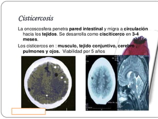 Cisticercosis parasitosis intestinal