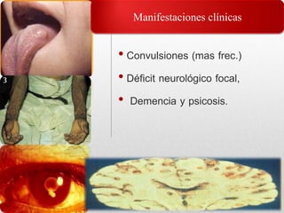 • Convulsiones (mas frec.)
• Déficit neurológico focal,
• Demencia y psicosis.
Manifestaciones clínicas
 
