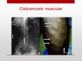 Cisticercosis muscular
 