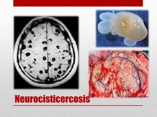 Neurocisticercosis
 