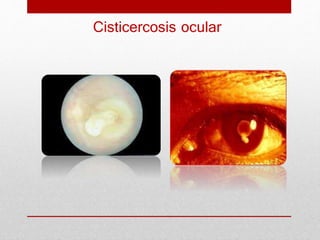 Cisticercosis ocular
 