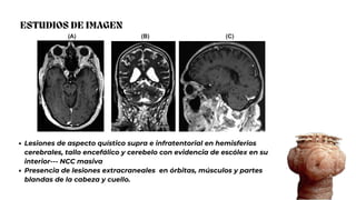 ESTUDIOS DE IMAGEN
Lesiones de aspecto quístico supra e infratentorial en hemisferios
cerebrales, tallo encefálico y cerebelo con evidencia de escólex en su
interior--- NCC masiva
Presencia de lesiones extracraneales en órbitas, músculos y partes
blandas de la cabeza y cuello.
 