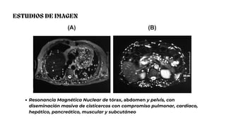 ESTUDIOS DE IMAGEN
Resonancia Magnética Nuclear de tórax, abdomen y pelvis, con
diseminación masiva de cisticercos con compromiso pulmonar, cardiaco,
hepático, pancreático, muscular y subcutáneo
 