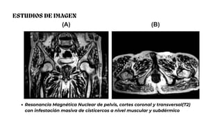 ESTUDIOS DE IMAGEN
Resonancia Magnética Nuclear de pelvis, cortes coronal y transversal(T2)
con infestación masiva de cisticercos a nivel muscular y subdérmico
 
