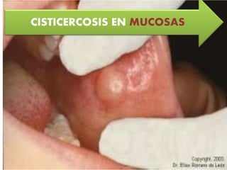 CISTICERCOSIS EN MUCOSAS
 