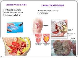 Cauzele cistitei la femei
 Infecţiile vaginale
 Infecţiile intestinale
 Expunerea la frig
Cauzele cistitei la bărbaţi
 Adenomul de prostată
 Prostatita
 