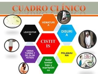 HEMATURI
                A

LEUCOCITUR               DISURI
    IA
                            A

             CISTIT
               IS
 ORINA
TURBIA Y                 POLAQUIU
DE OLOR                     RIA
 FÉTIDO
               Dolor
              lumbar
               bajo y
             suprapúbi
                co
 