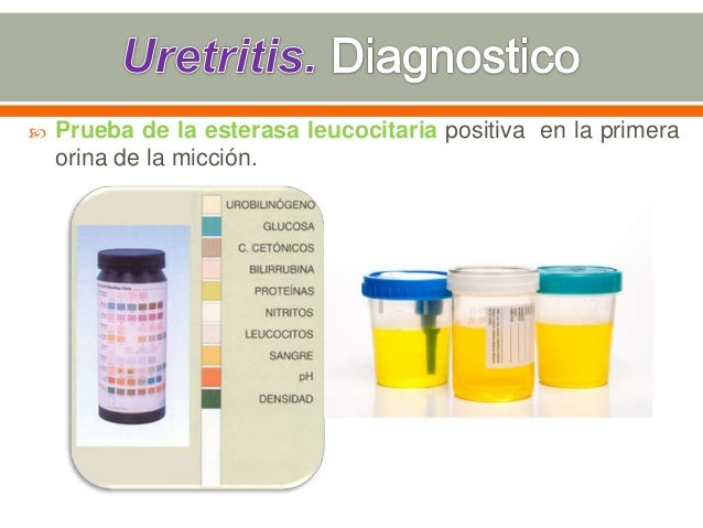 Cistitis Cistitis