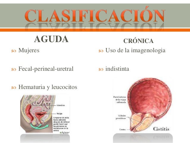 Cistitis Cistitis