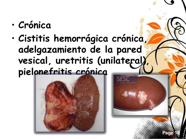 Cistitis Cistitis
