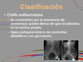 • Cistitis enfisematosa
– Se caracteriza por la presencia de
numerosos quistes llenos de gas localizados
en la lamina propia.
– Signo patognomónico de pacientes
diabéticos con glucosuria.
 