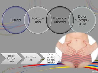 Disuria
Polaqui-
uria
Urgencia
urinaria
Dolor
suprapú-
bico
Dolor
lumbar
bajo
Hematu
ria
Orina
turbia y
de olor
fétido
 
