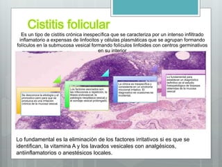 Cistitis folicular
Se desconoce la etiología y el
pronostico pero para que se
produzca es una irritación
crónica de la mucosa vesical.
Los factores asociados son
las infecciones a repetición, la
litiasis endovesical, la
patología neoplásica vesical y
el sondaje vesical prolongado.
La clínica es inespecífica y
consistente en un síndrome
miccional irritativo. El
diagnostico es ocasiones es
incidental.
Lo fundamental para
establecer un diagnóstico
definitivo es el estudio
histopatológico de biopsias
obtenidas de la mucosa
vesical
Es un tipo de cistitis crónica inespecífica que se caracteriza por un intenso infiltrado
inflamatorio a expensas de linfocitos y células plasmáticas que se agrupan formando
folículos en la submucosa vesical formando folículos linfoides con centros germinativos
en su interior
Lo fundamental es la eliminación de los factores irritativos si es que se
identifican, la vitamina A y los lavados vesicales con analgésicos,
antiinflamatorios o anestésicos locales.
 