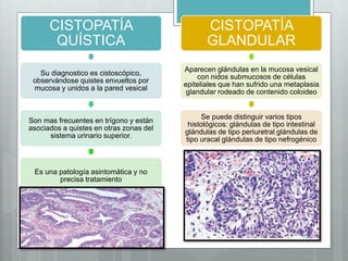 CISTOPATÍA
QUÍSTICA
Su diagnostico es cistoscópico,
observándose quistes envueltos por
mucosa y unidos a la pared vesical
Son mas frecuentes en trígono y están
asociados a quistes en otras zonas del
sistema urinario superior.
Es una patología asintomática y no
precisa tratamiento
CISTOPATÍA
GLANDULAR
Aparecen glándulas en la mucosa vesical
con nidos submucosos de células
epiteliales que han sufrido una metaplasia
glandular rodeado de contenido coloideo
Se puede distinguir varios tipos
histológicos: glándulas de tipo intestinal
glándulas de tipo periuretral glándulas de
tipo uracal glándulas de tipo nefrogénico
 