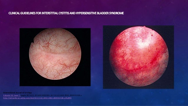 Cistitis Intersticial, 2015