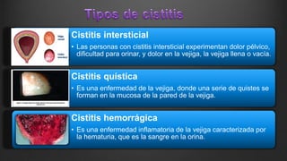Cistitis intersticial
• Las personas con cistitis intersticial experimentan dolor pélvico,
dificultad para orinar, y dolor en la vejiga, la vejiga llena o vacía.
Cistitis quística
• Es una enfermedad de la vejiga, donde una serie de quistes se
forman en la mucosa de la pared de la vejiga.
Cistitis hemorrágica
• Es una enfermedad inflamatoria de la vejiga caracterizada por
la hematuria, que es la sangre en la orina.
 