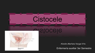 Cistocele
Alondra Marlene Vargas Vite
 