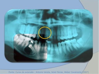 Fonte: Curso de extensão - Antonio Varela, Jener Farias, Weber Cavalcante (2007)
 