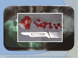 Fonte: Curso de extensão - Antonio Varela, Jener Farias, Weber Cavalcante (2007)
 