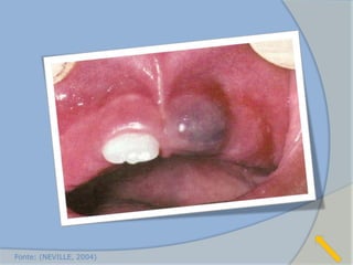 Fonte: (NEVILLE, 2004)
 